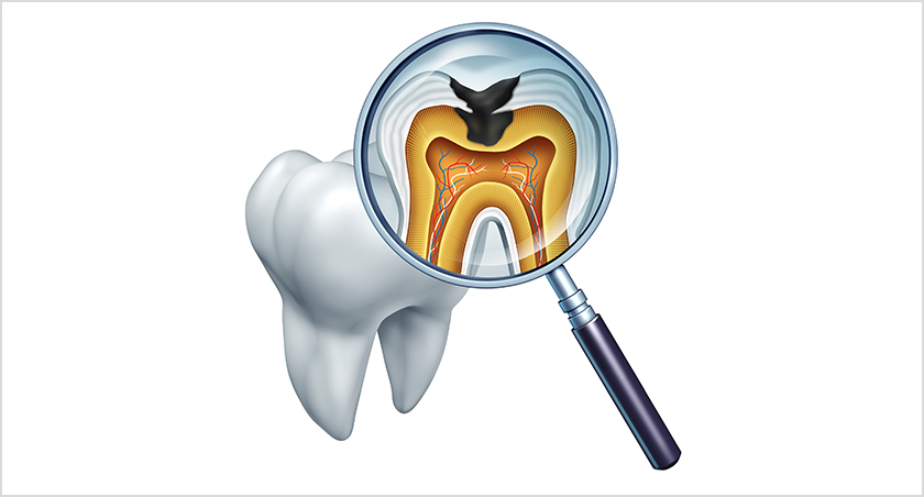 重度の虫歯は根管治療