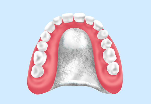 自費の入れ歯