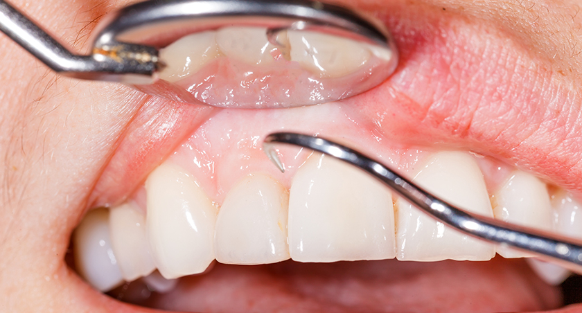歯ぐきの腫れや出血～歯周病治療