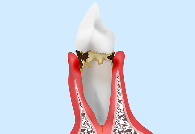 細菌によって引き起こされる歯周病