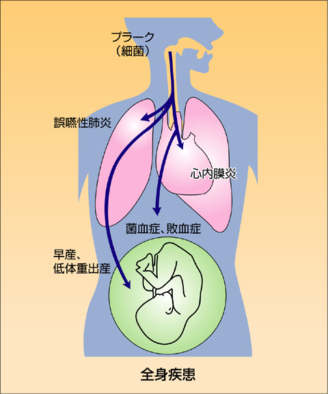 歯周病菌と全身疾患の関係性