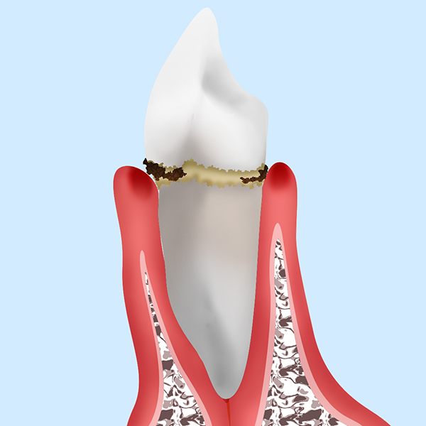 歯肉炎や軽度歯周炎